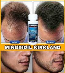 🚫 Basta de excusas, basta de caída 💧 MINOXIDIL™ 5% & 6% — Tú mereces verte bien"